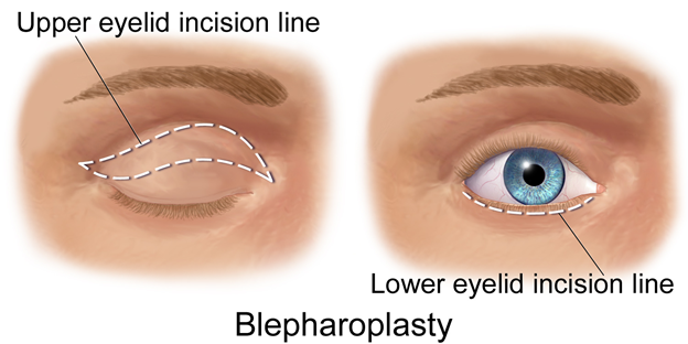 Blepharoplasty Diagram